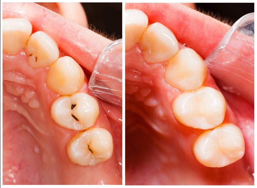 Natural-looking tooth-colored composite filling seamlessly blended with tooth
